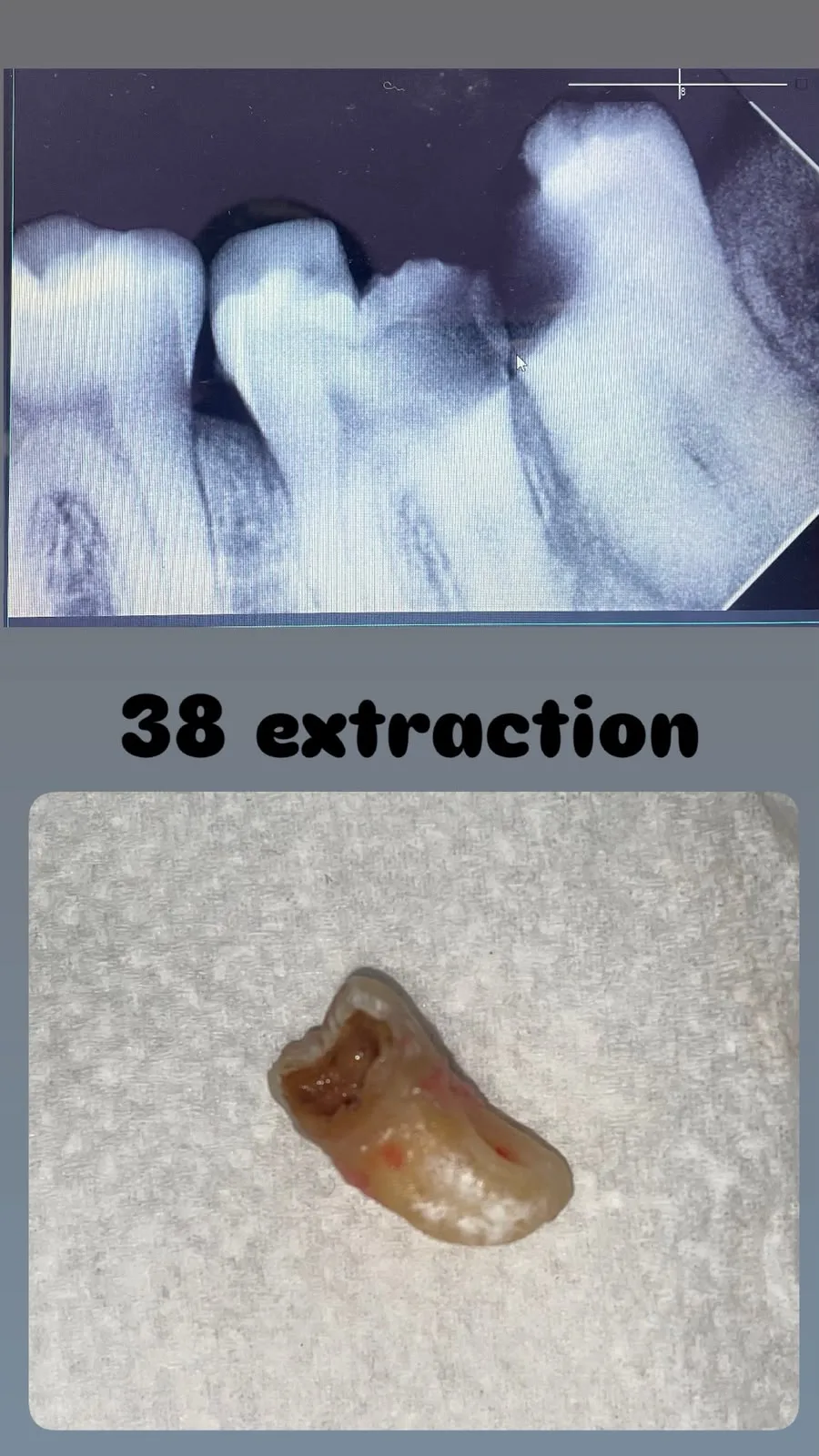 Lower Wisdom Tooth 38 Extraction Result