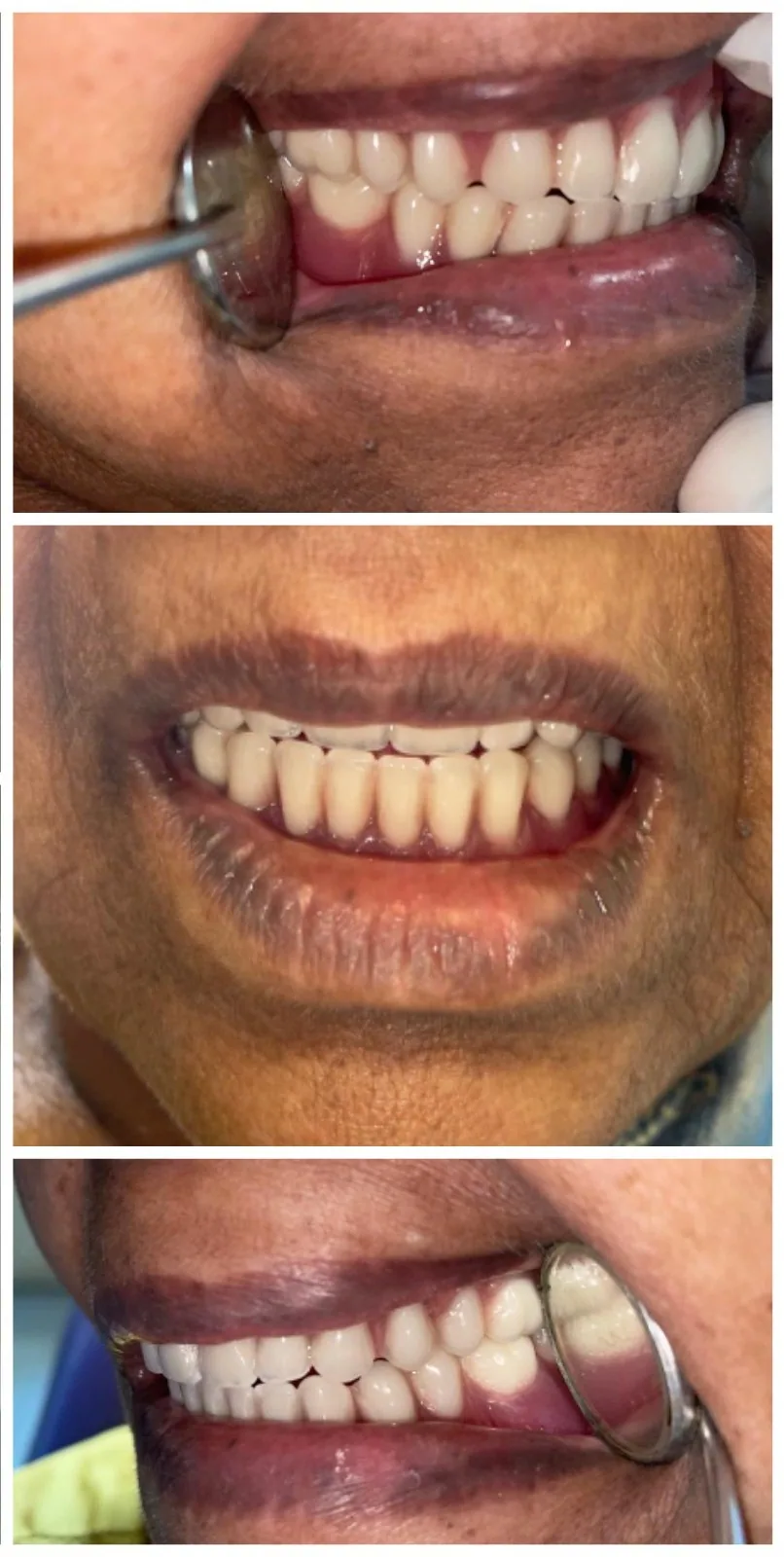 Custom Complete Denture Fabrication Result