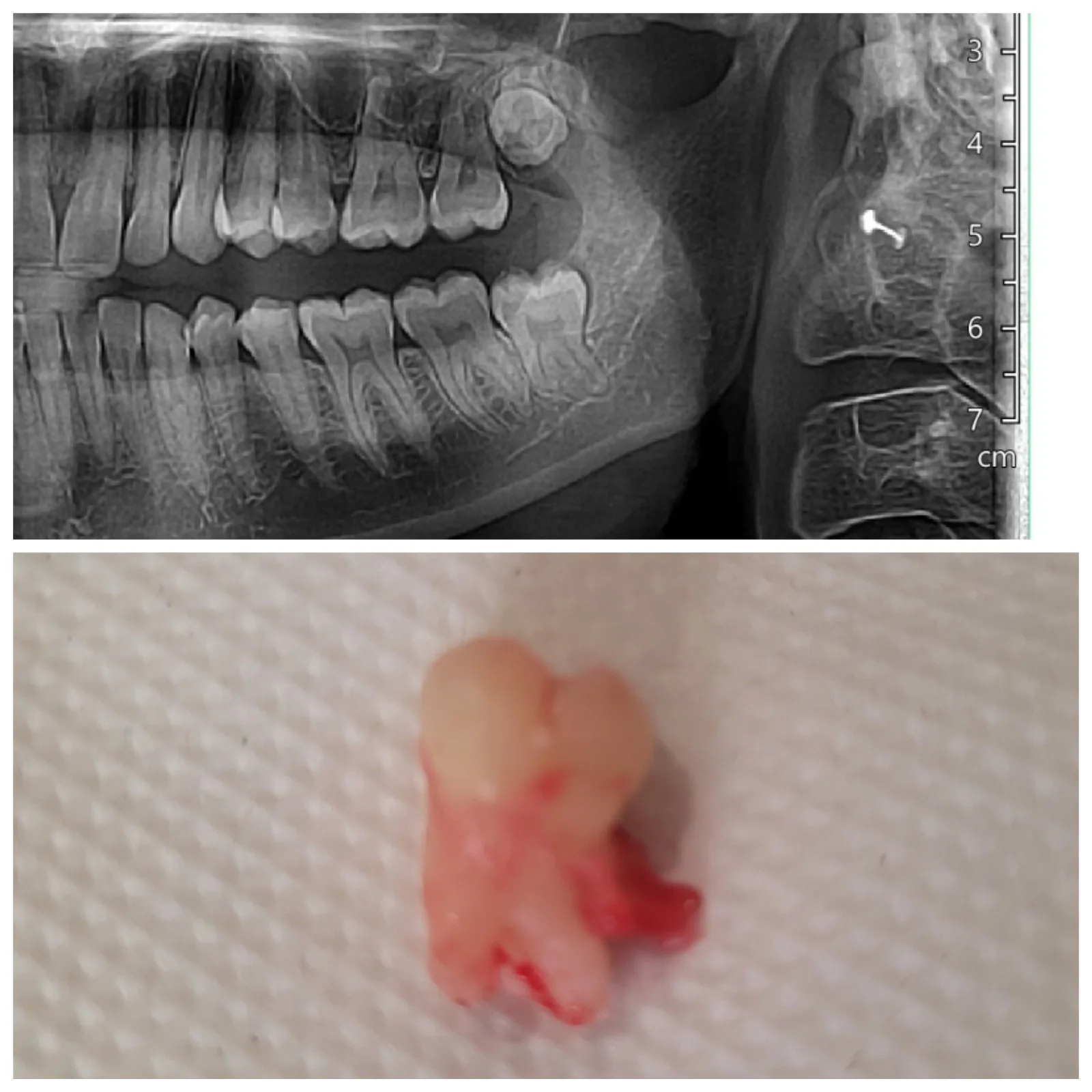 Vertically Impacted Lower Wisdom Tooth 38 Removal